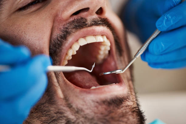 Best Dental Abscess Treatment in Belmont, CA